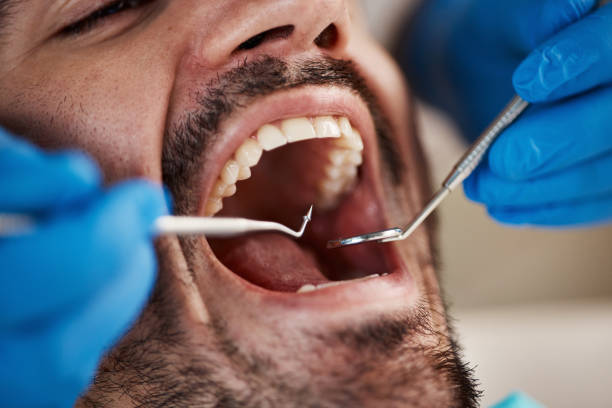 Dental Bonding in Choctaw, OK